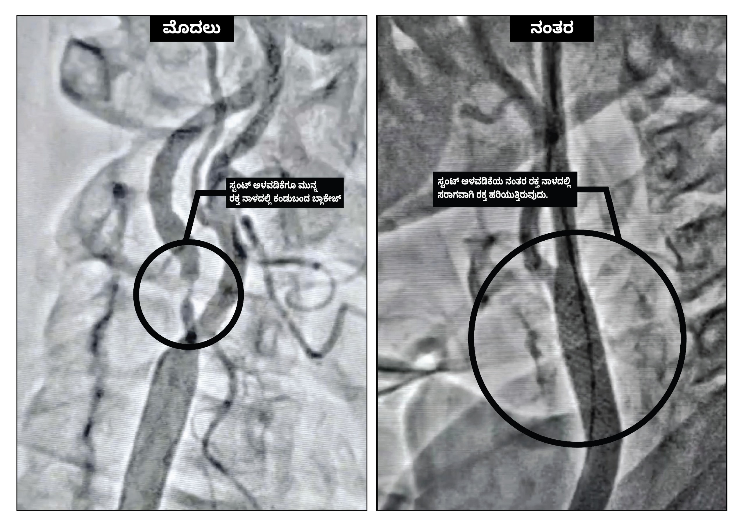 Carotid Artery Stunting Procedure
